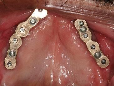 Fully edentulous clinical cases 1