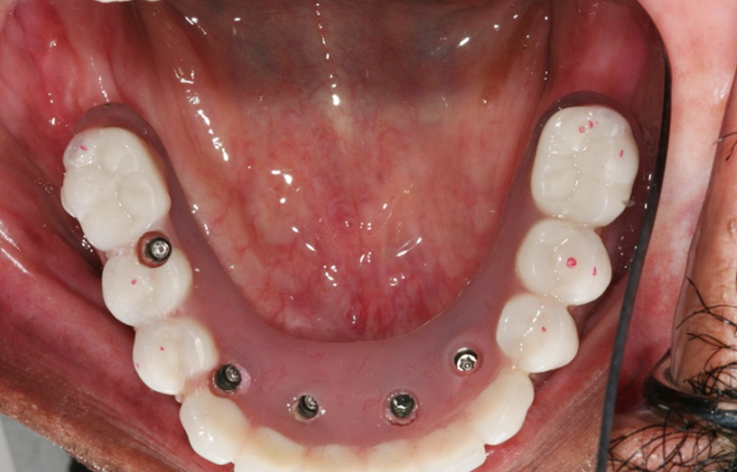 Fully edentulous clinical cases 10