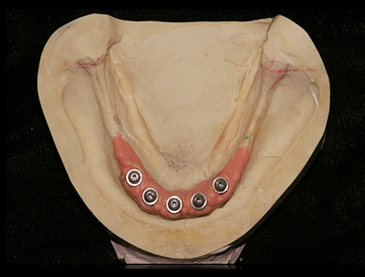 Fully edentulous clinical cases 12