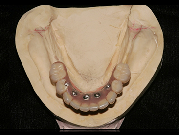 Fully edentulous clinical cases 13