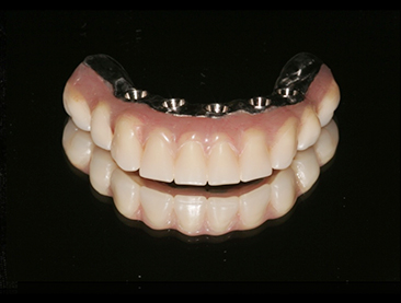 Fully edentulous clinical cases 14