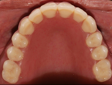 Fully edentulous clinical cases 16