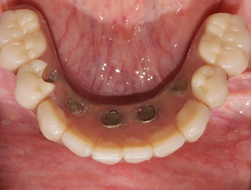 Fully edentulous clinical cases 17