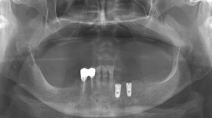 Fully edentulous clinical cases 19