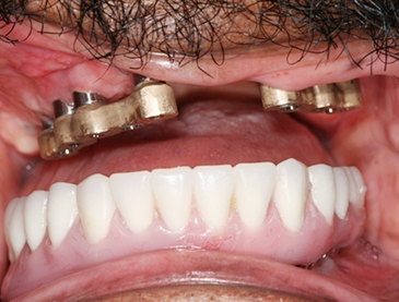 Fully edentulous clinical cases 2