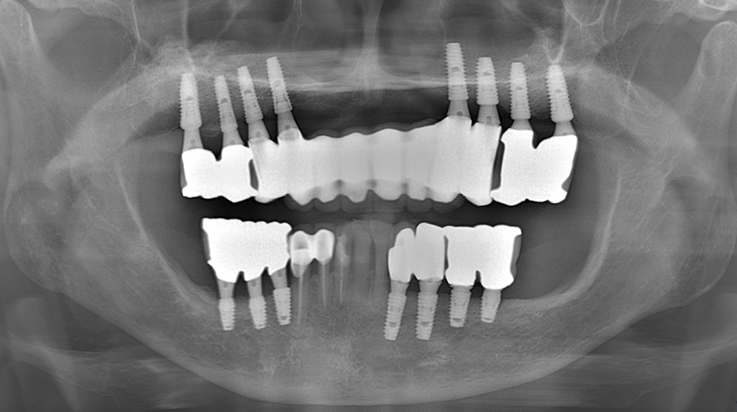 Fully edentulous clinical cases 20