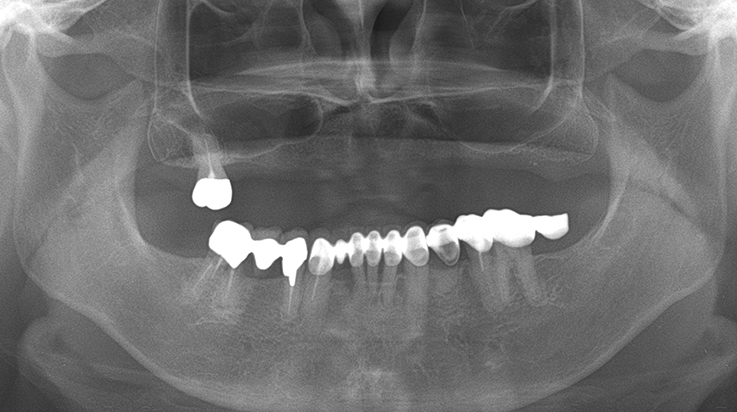 Fully edentulous clinical cases 21