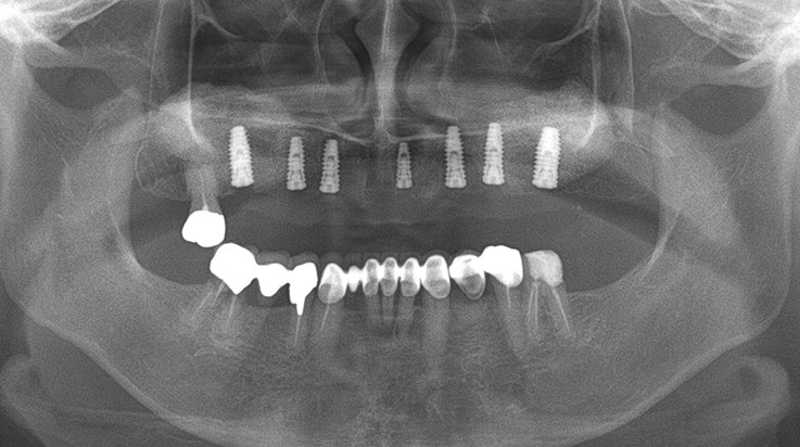 Fully edentulous clinical cases 22