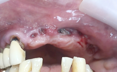 Fully edentulous clinical cases 23