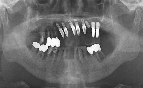 Fully edentulous clinical cases 26