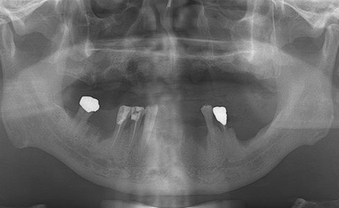 Fully edentulous clinical cases 27