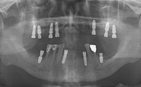 Fully edentulous clinical cases 28