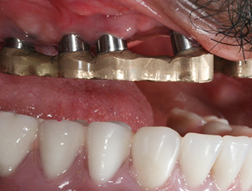 Fully edentulous clinical cases 3