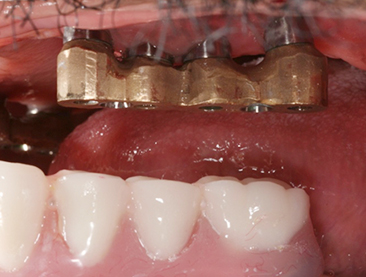 Fully edentulous clinical cases 4