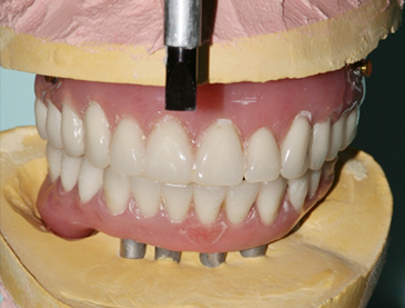 Fully edentulous clinical cases 6