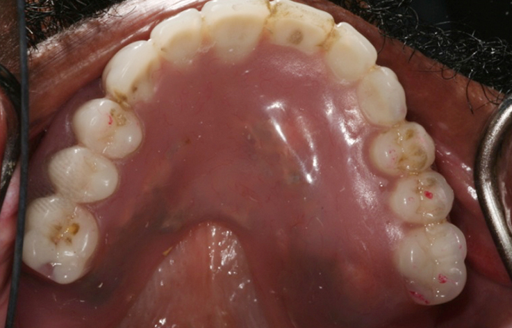 Fully edentulous clinical cases 9