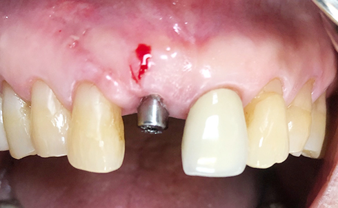 Overview of Implant Placement 11