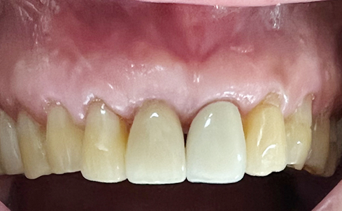 Overview of Implant Placement 12