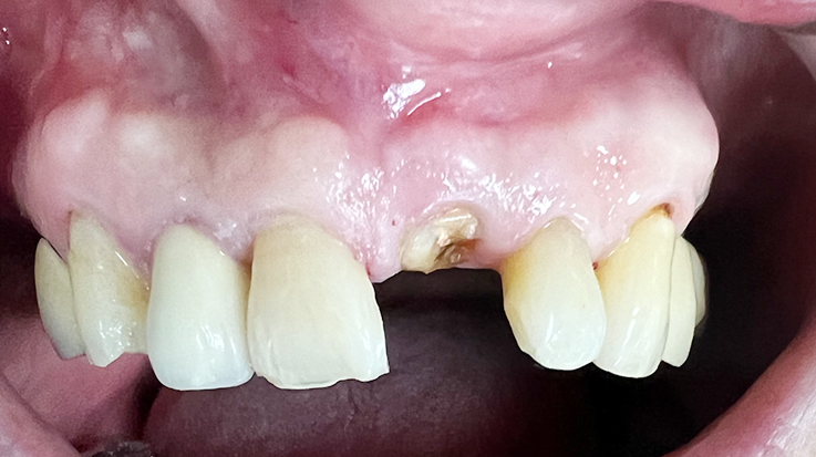 Overview of Implant Placement 13