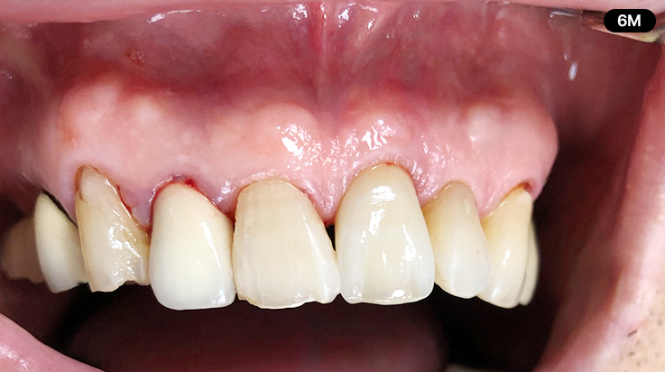 Overview of Implant Placement 14