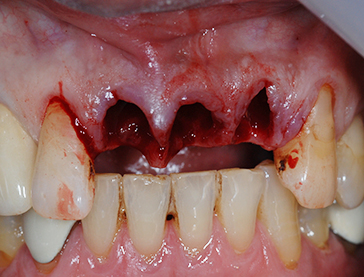 Overview of Implant Placement 17