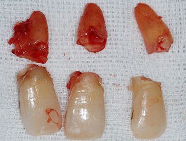 Overview of Implant Placement 18