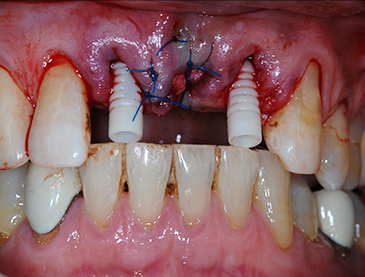 Overview of Implant Placement 19