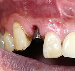 Overview of Implant Placement 1