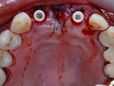 Overview of Implant Placement 20