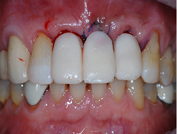 Overview of Implant Placement 21