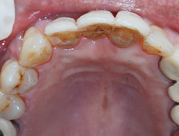 Overview of Implant Placement 22