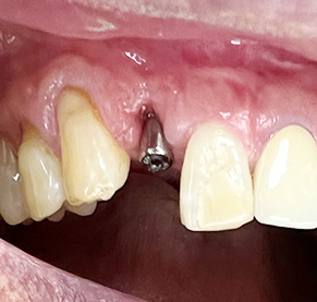 Overview of Implant Placement 3