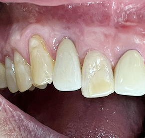 Overview of Implant Placement 4