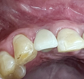 Overview of Implant Placement 5