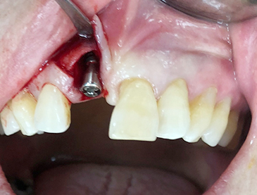 Overview of Implant Placement 7