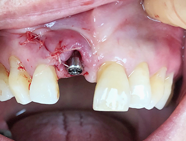 Overview of Implant Placement 8