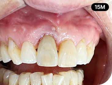 Overview of Implant Placement 9