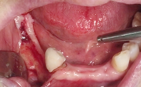 Partial edentulous clinical cases 1