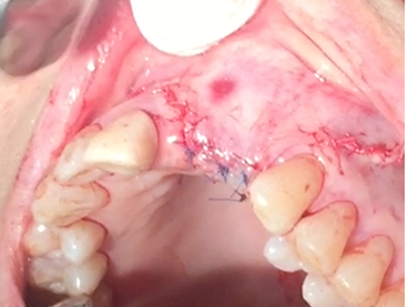 Partial edentulous clinical cases 10