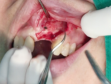 Partial edentulous clinical cases 11