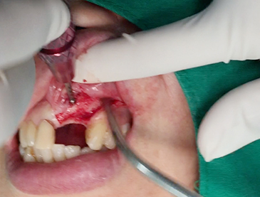 Partial edentulous clinical cases 12