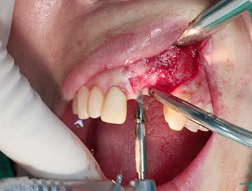 Partial edentulous clinical cases 13