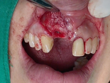 Partial edentulous clinical cases 14