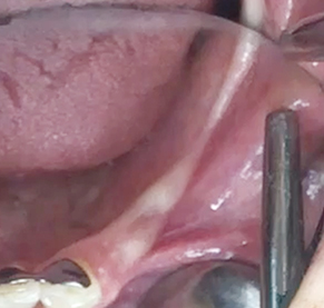 Partial edentulous clinical cases 15