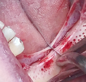 Partial edentulous clinical cases 16