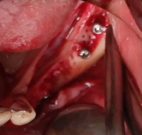 Partial edentulous clinical cases 17