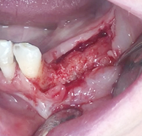 Partial edentulous clinical cases 18