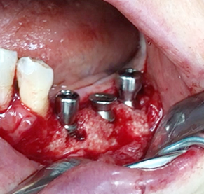 Partial edentulous clinical cases 19