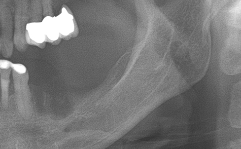 Partial edentulous clinical cases 20