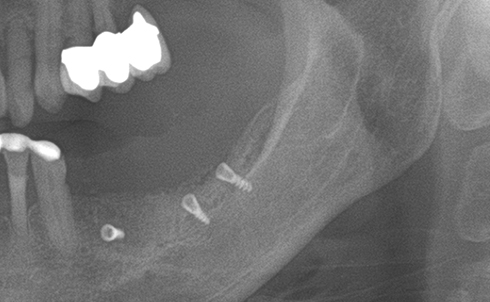 Partial edentulous clinical cases 21